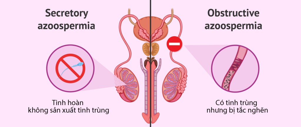 vô sinh nam do không có tinh trùng