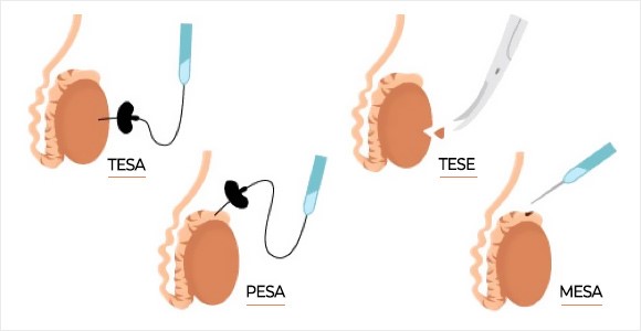 phẫu thuật tìm tinh trùng