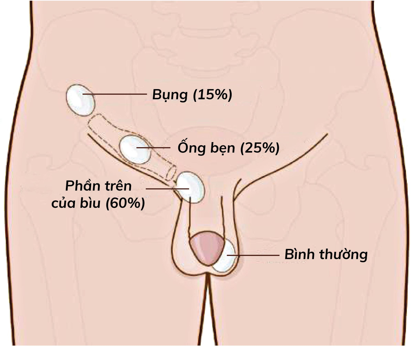 Tinh hoàn ẩn ở trẻ dẫn đến vô sinh hiếm muộn sau này