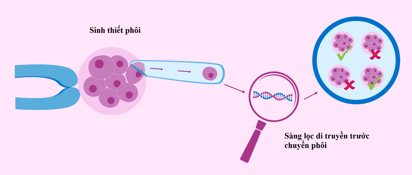 chuyển phôi khảm trong pgt